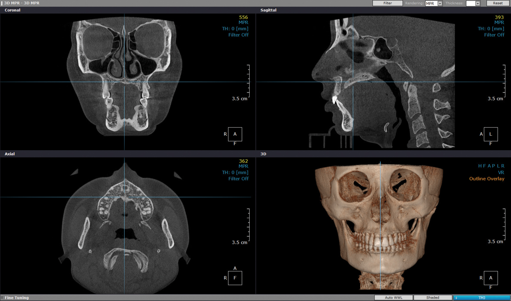 Dentri Sistema Dental CBCT TAC 3D Recursos Médicos