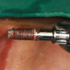 FR Kit Extractor de implantes