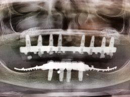 Implantologia en atrofias del seno