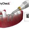AnyCheck medidor de estabilidad de implantes