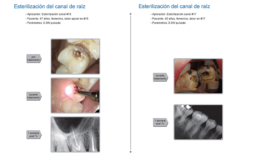 Casos clínicos K2 mobile: endodoncia